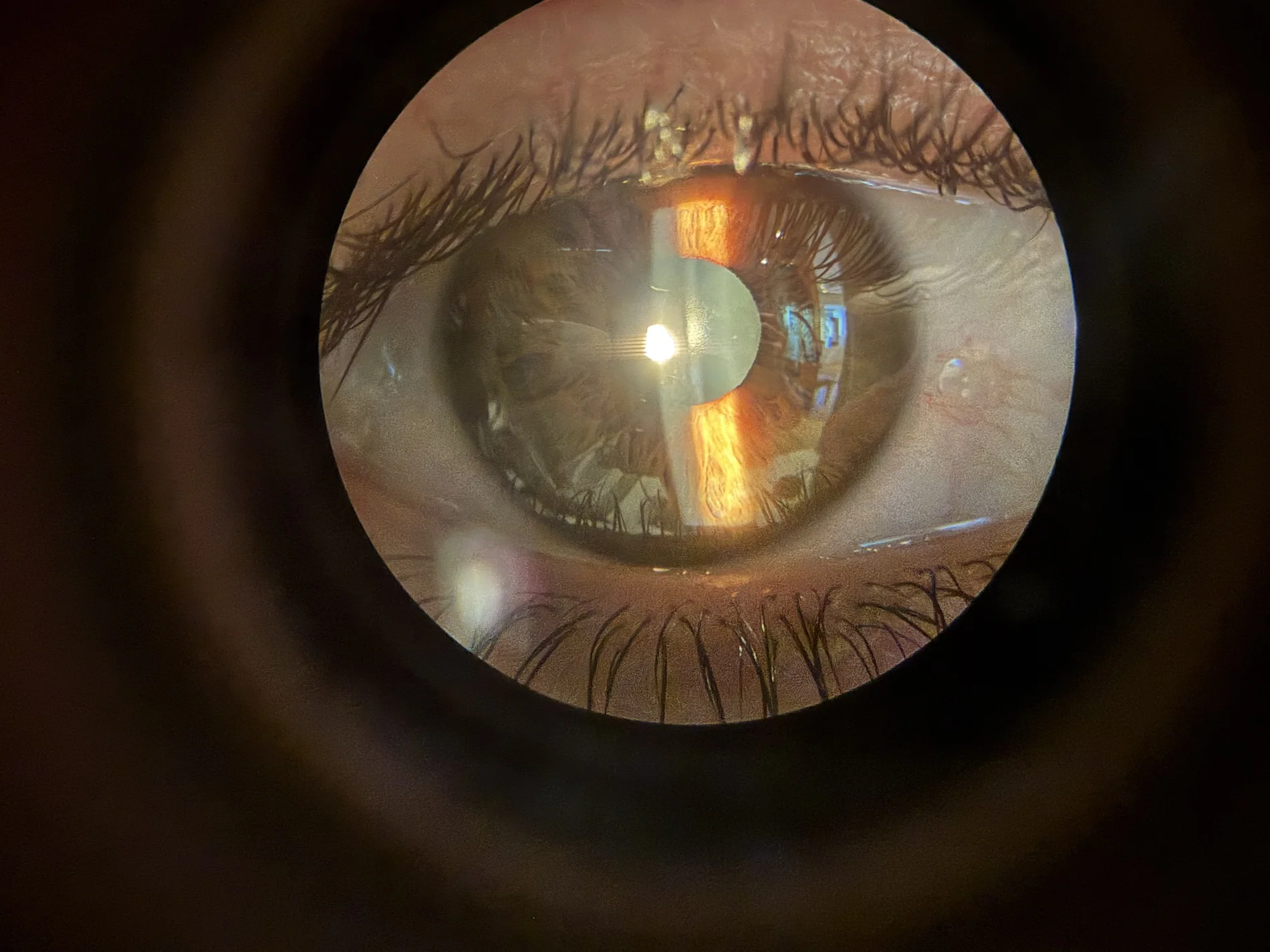 Detalle biomicroscópico del segmento anterior del ojo